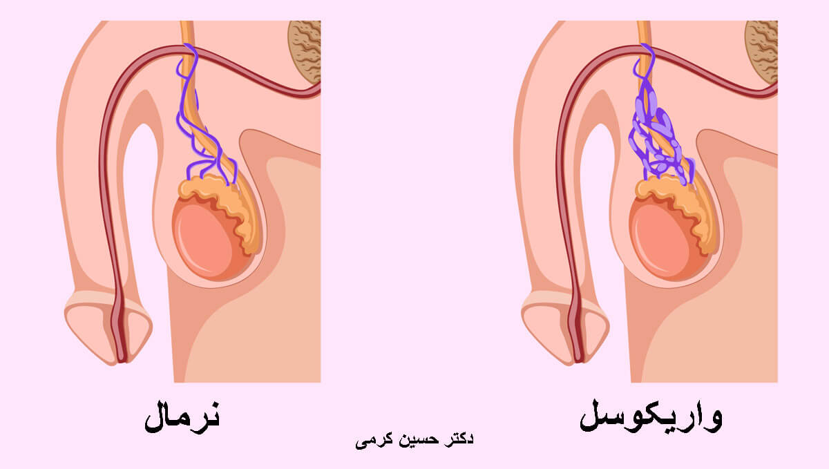 واریکوسل چیست؟ فیلم جراحی واریکوسل | دکتر کرمی