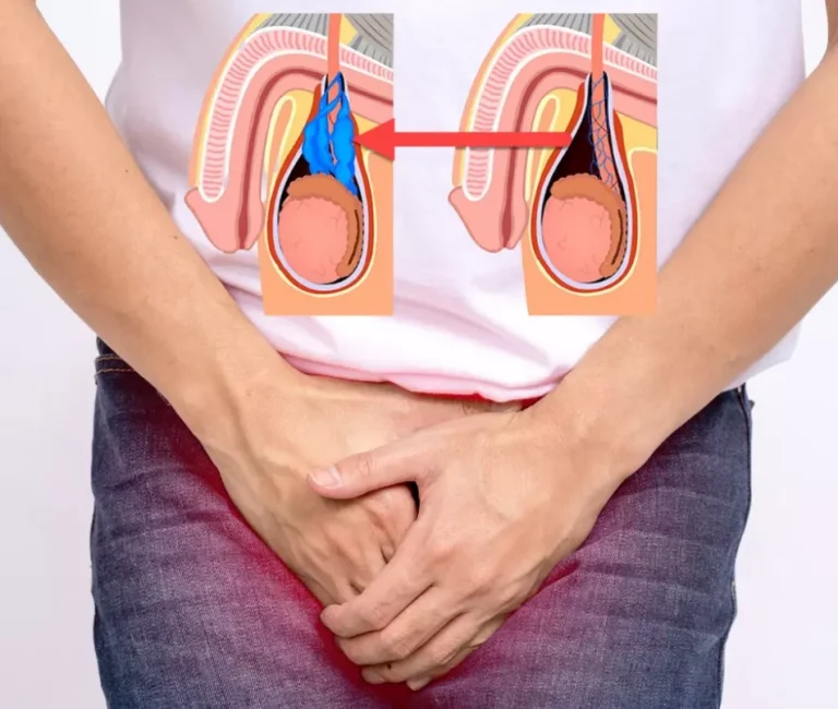 واریکوسل گرید 2