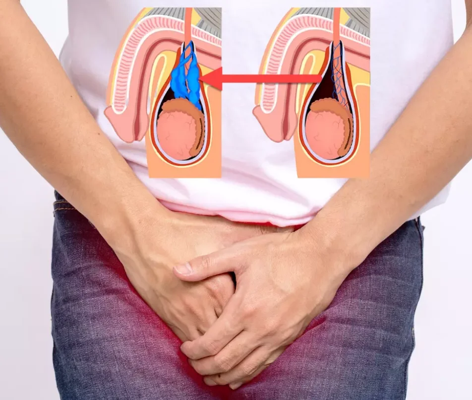 واریکوسل گرید 2