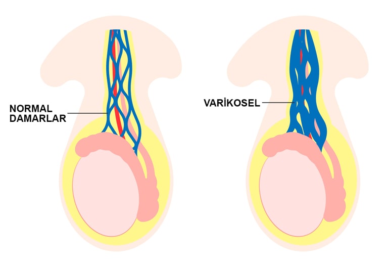 واریکوسل یا واریس بیضه