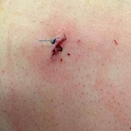 خارج كردن سنگ كلیه روش pcnl