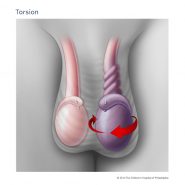 torsion پیچ خوردگی بیضه