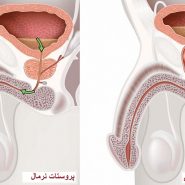 بزرگ شدن پروستات