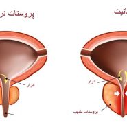 التهاب پروستات