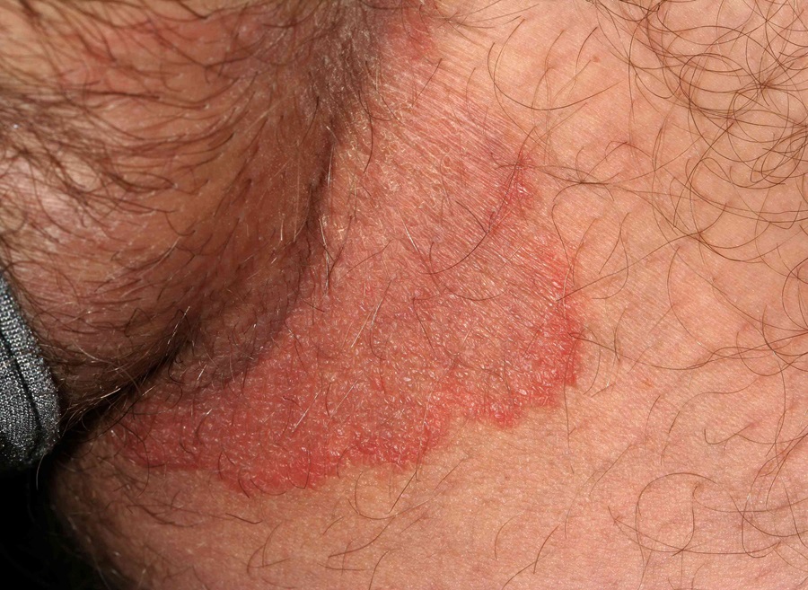 عفونت قارچی ژوک 