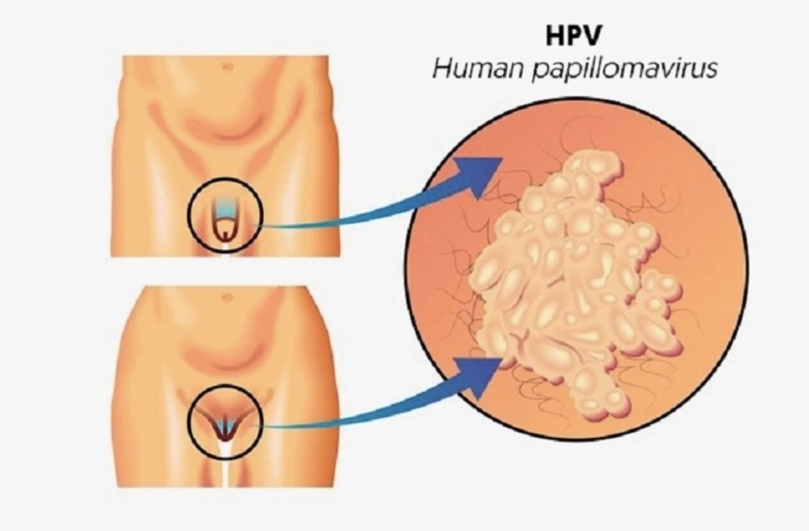 HPV اچ پی وی در زنان چه علائمی دارد/هزینه آزمایش اچ پی وی چقدر است