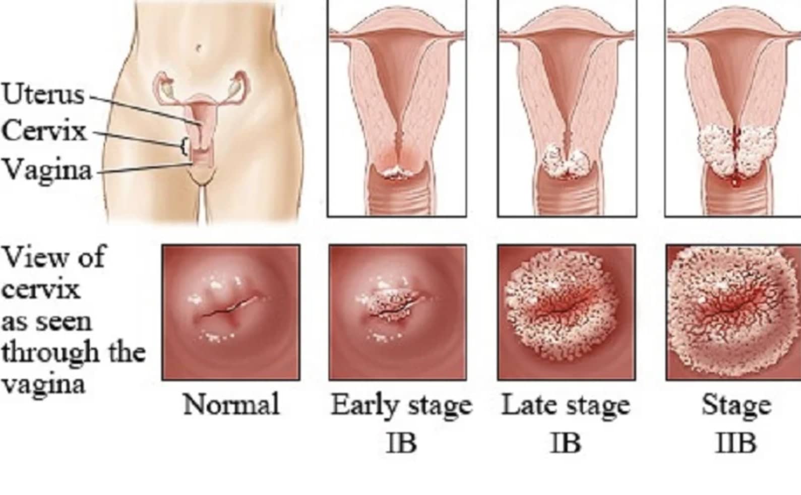 علایم hpv در زنان