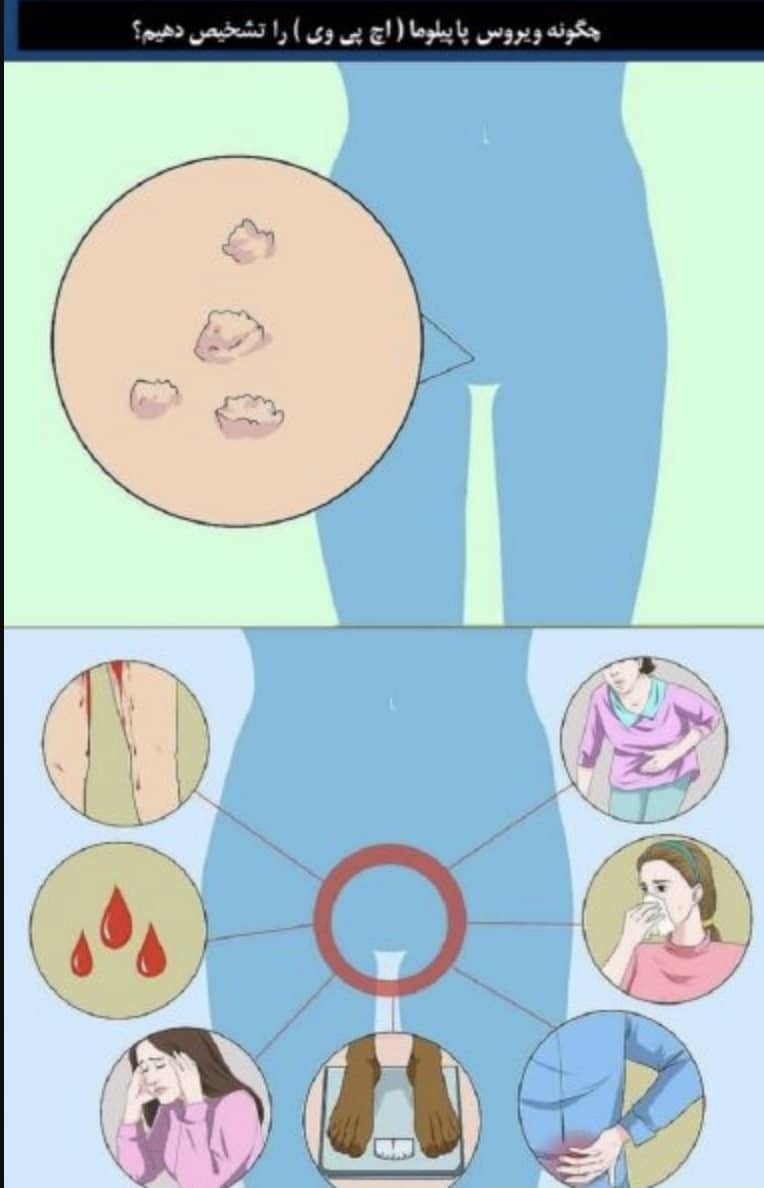 علایم زگیل در زنان