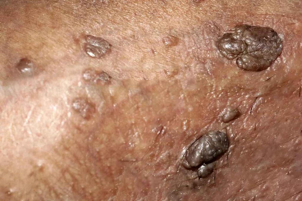 عکس زگیل و تفاوتش با جوش