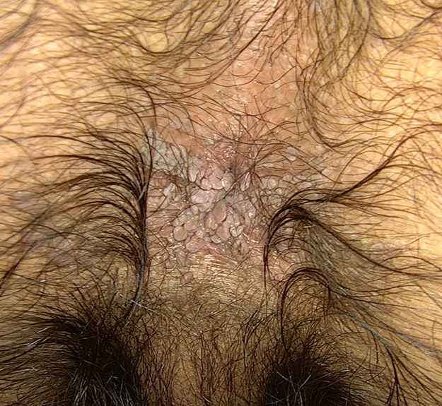 آزمایش hpv