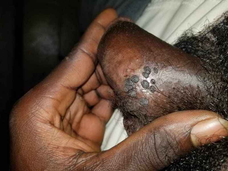 نحوه آزمایش hpv در مردان