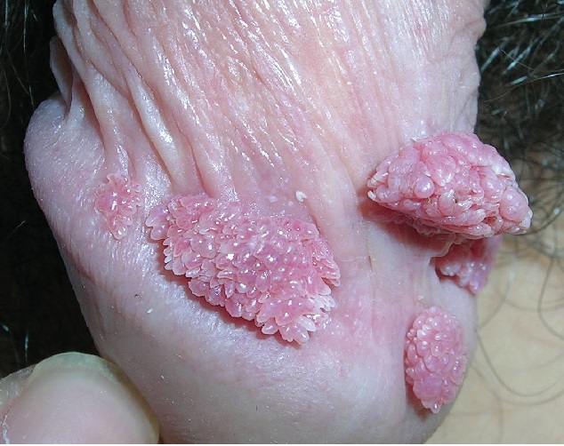 زگیل دور کلاهک کیر