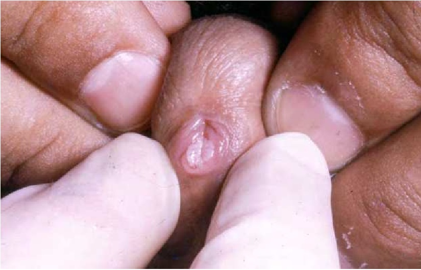 زگیل تناسلی داخل سوراخ کلاهک آلت