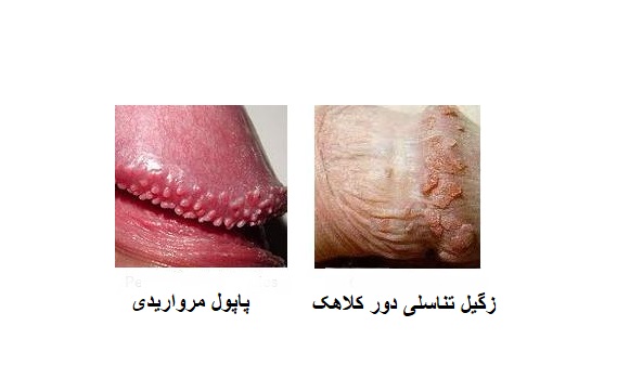 تفاوت زگیل دور کلاهک با پاپول مرواریدی