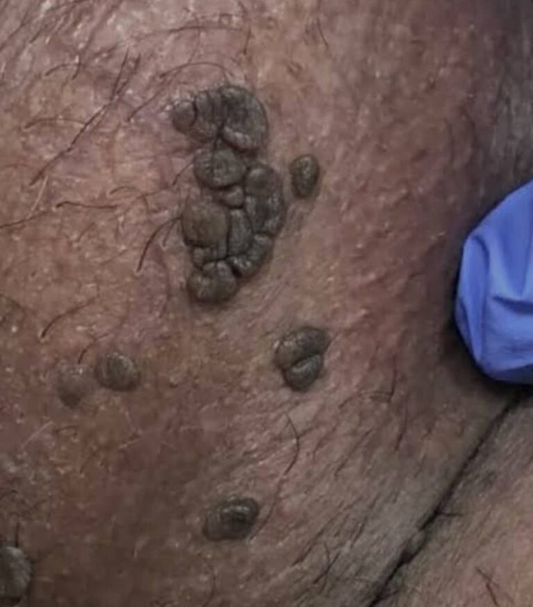 زگیل تناسلی پر خطر