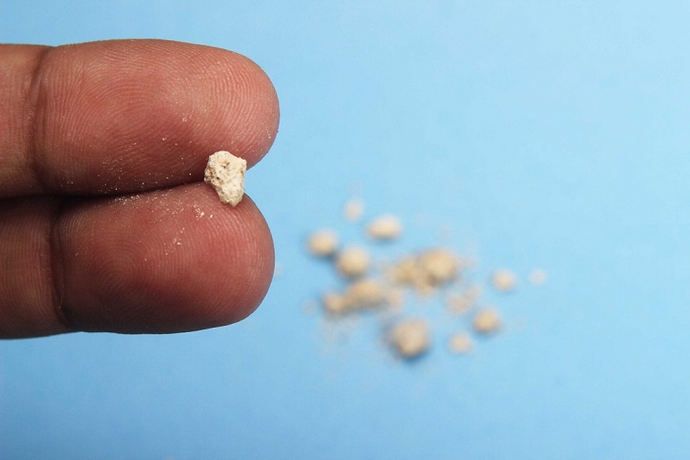 شن ریزه های کلیه