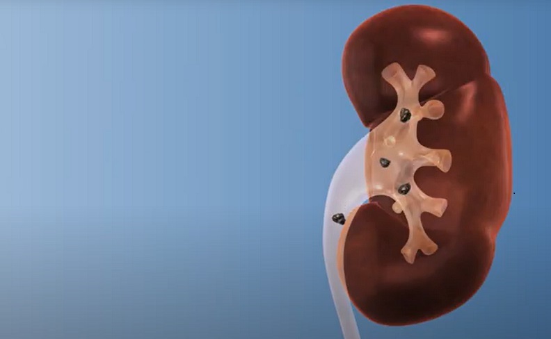 دفع سنگ کلیه خیلی ریز